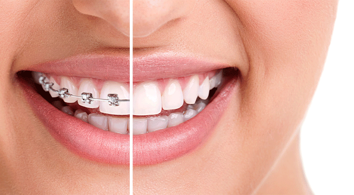 Smile Designing